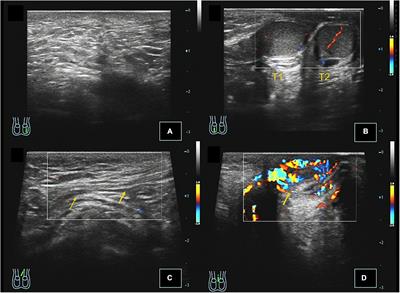 Diagnostic value of ultrasound in children with transverse testicular ectopia